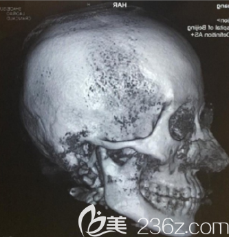 韩国本爱做轮廓怎么样 韩国本爱做轮廓怎么样