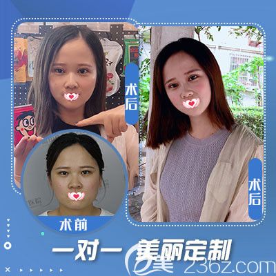 蓝山整形医院做双眼皮案例 蓝山整形医院做双眼皮案例