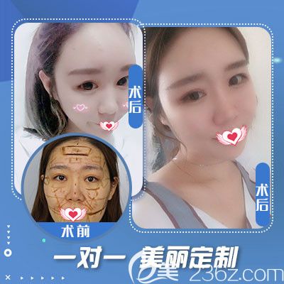 石家庄蓝山自体脂肪填充面部案例 石家庄蓝山自体脂肪填充面部案例