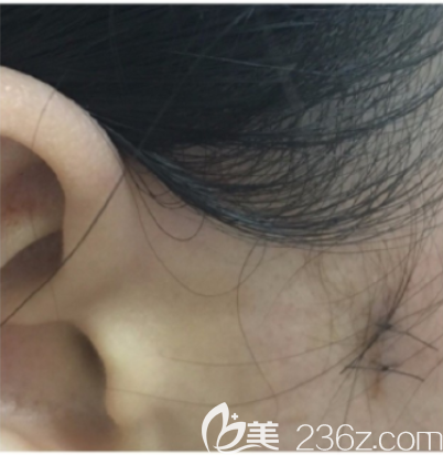 说一说我在韩国本爱整形找文圣昊做颧弓内推的经历吧