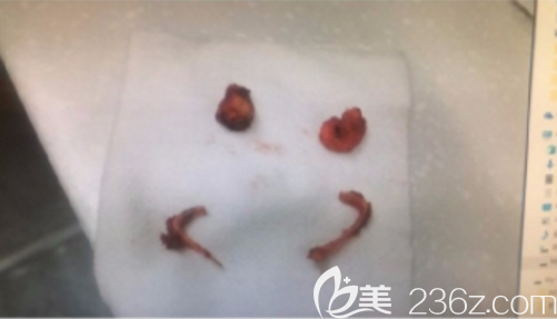 韩国本爱整形文圣昊颧骨内退案例 韩国本爱整形文圣昊颧骨内退案例