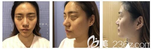 面诊苏州康美术前面部凹陷严重 面诊苏州康美术前面部凹陷严重