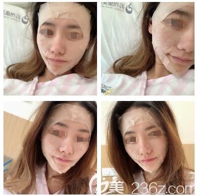 刚做完面部脂肪填充恢复中 刚做完面部脂肪填充恢复中