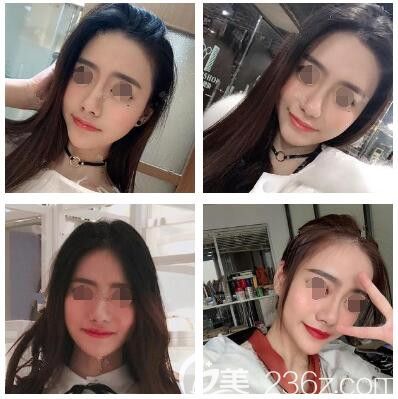 做完自体脂肪面部填充术后十天恢复 做完自体脂肪面部填充术后十天恢复