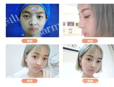 郑州医德佳胡斌眼综合案例