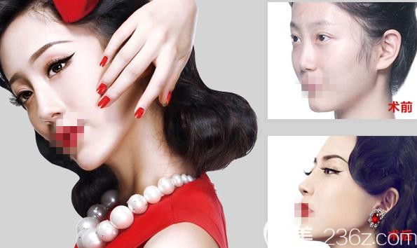 郑州医德佳整形医院 鼻综合前后对比