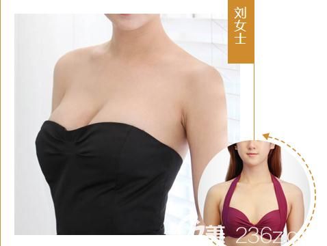 郑州医德佳自体脂肪丰胸前后对比