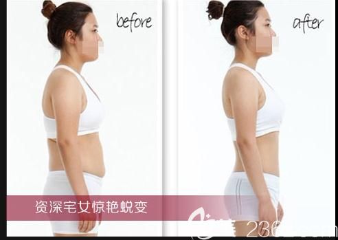 郑州医德佳整形吸脂瘦身案例