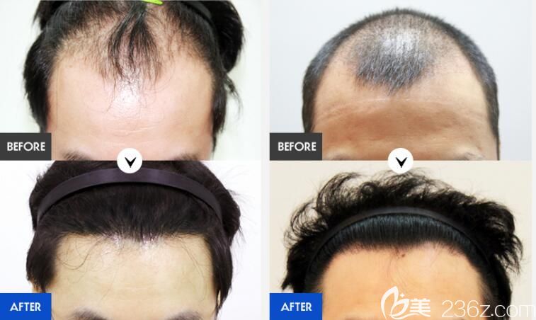 韩国forhair植发医院男士植发案例效果对比图 韩国forhair植发医院男士植发案例效果对比图