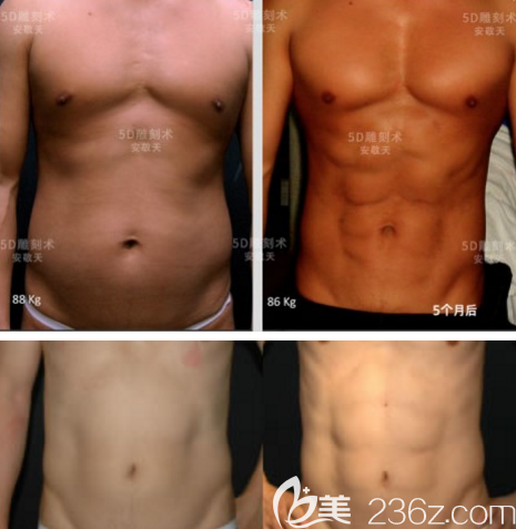 韩国cellpia整形医院安敬天吸脂案例