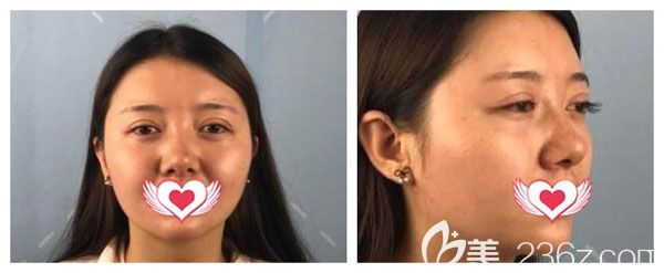 在昆明梦想做双眼皮失败修复前 在昆明梦想做双眼皮失败修复前