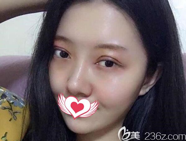 全切双眼皮第7天眼周的淤青已经慢慢变黄 全切双眼皮第7天眼周的淤青已经慢慢变黄