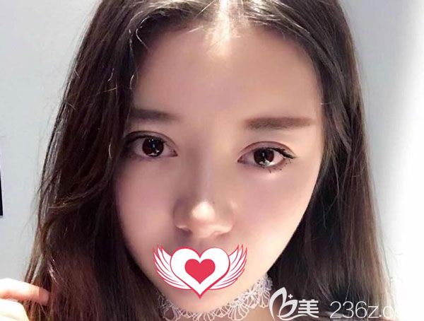 双眼皮修复手术20天形态看起来非常自然 双眼皮修复手术20天形态看起来非常自然