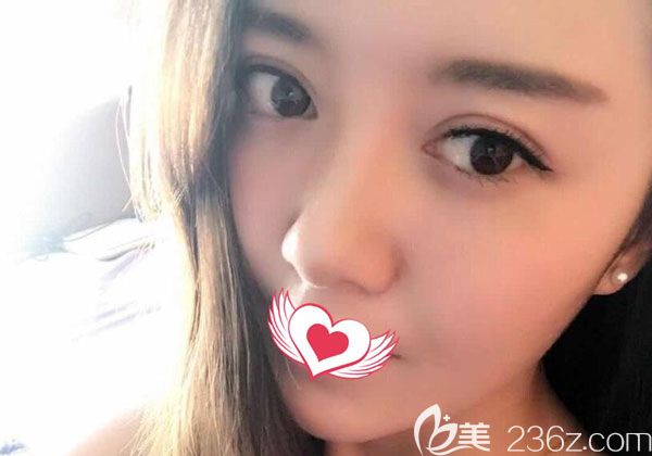 全切双眼皮修复1个月基本已经定型 全切双眼皮修复1个月基本已经定型