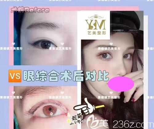 景德镇艺美整形虞国锋主任做的全切双眼皮+开眼角案例效果