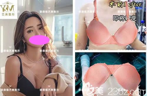 景德镇艺美整形虞国锋主任做的曼托假体隆胸案例效果