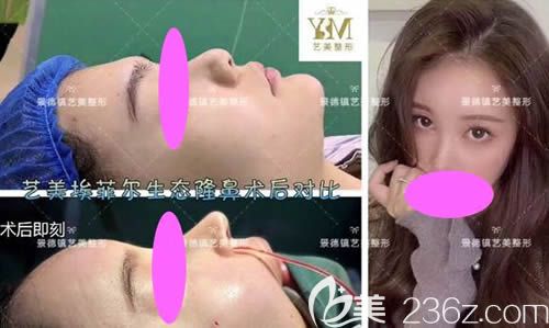景德镇艺美整形虞国锋主任做的假体+肋软骨隆鼻案例效果