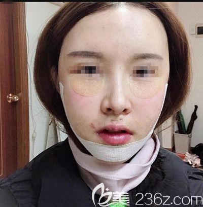 韩国EU做面部轮廓手术第1天