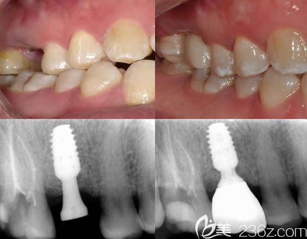 北京牙管家口腔<!--<i data=20240703-sp></i>-->波美学种植案例效果前后对比图 北京牙管家口腔<!--<i data=20240703-sp></i>-->波美学种植案例效果前后对比图