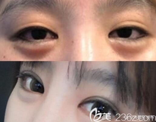 韩国raffine整形外科皮肤科眼部综合整形案例效果对比图 韩国raffine整形外科皮肤科眼部综合整形案例效果对比图