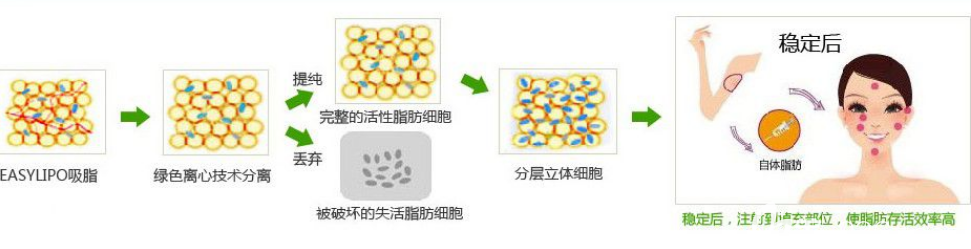脂肪移植手术过程示意图