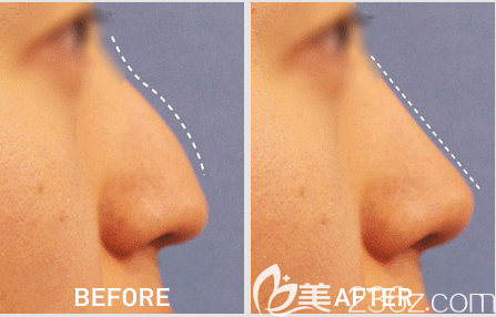 韩国lucea隆鼻手术<span style= 韩国lucea隆鼻手术<span style=