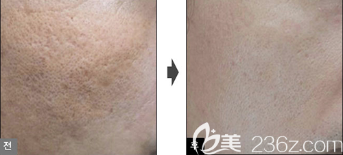 韩国lucea激光美肤案例 韩国lucea激光美肤案例