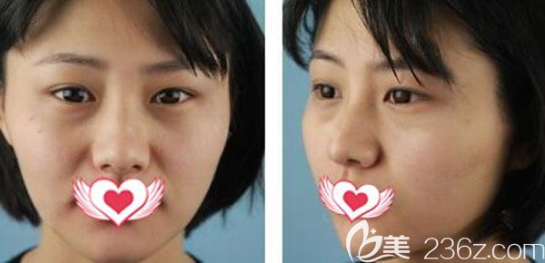 在昆明梦想做自体脂肪面部填充前 在昆明梦想做自体脂肪面部填充前