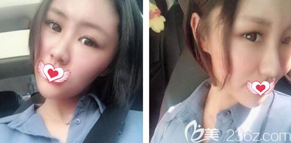 自体脂肪全脸填充术后第7天摸着很平整 自体脂肪全脸填充术后第7天摸着很平整