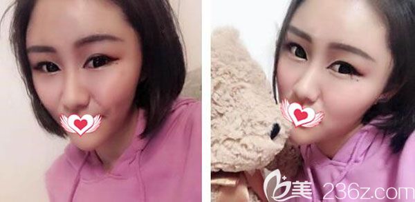 自体脂肪填充一个月已经定型没有出现大小脸 自体脂肪填充一个月已经定型没有出现大小脸