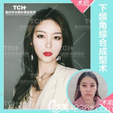 重庆时光下颌角整形案例 重庆时光下颌角整形案例