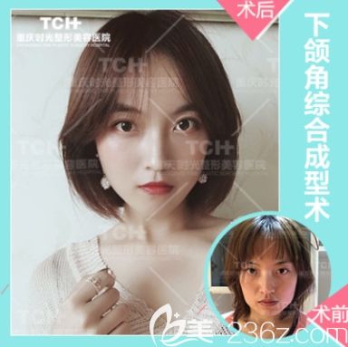 重庆时光下颌角整形 重庆时光下颌角整形