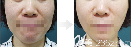 韩国lucea整形医院面部提升手术案例 韩国lucea整形医院面部提升手术案例