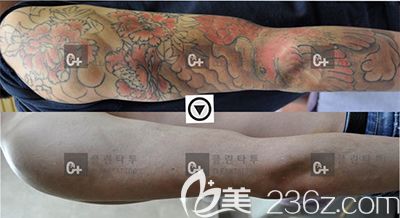 韩国Clean Tattoo手臂去纹身案例 韩国Clean Tattoo手臂去纹身案例