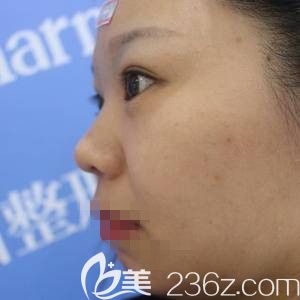 郑州医德佳索慧珠做假体垫下巴前 郑州医德佳索慧珠做假体垫下巴前