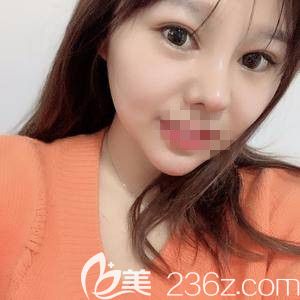 郑州医德佳索慧珠做假体垫下巴术后45天 郑州医德佳索慧珠做假体垫下巴术后45天