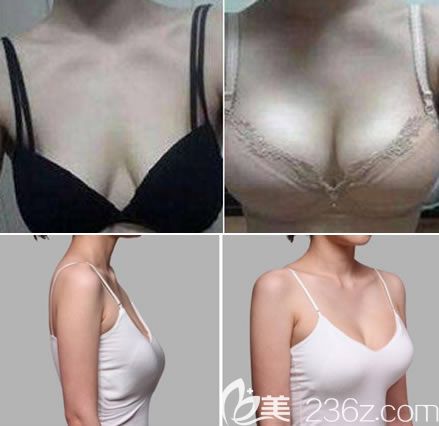 杭州时光乳房下垂矫正真人案例