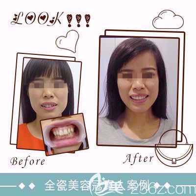 石家庄雅芳亚做美容冠案例