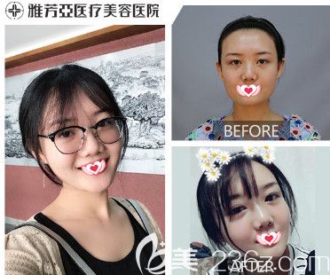 雅芳亚整形注射瘦脸案例