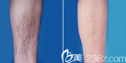 在南京维多利亚小腿脱毛前后对比照 在南京维多利亚小腿脱毛前后对比照