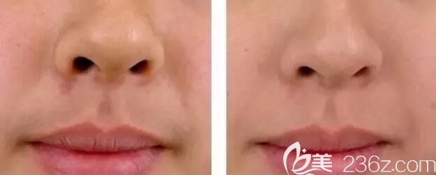 到南京维多利亚唇部脱毛前后对比照 到南京维多利亚唇部脱毛前后对比照