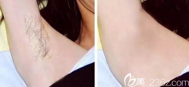 南京维多利亚分享腋下脱毛前后对比照 南京维多利亚分享腋下脱毛前后对比照