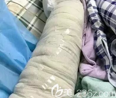 我在南宁梦想做360大腿吸脂术后第3天 我在南宁梦想做360大腿吸脂术后第3天