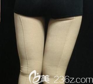 我在南宁梦想做大腿吸脂术后第7天 我在南宁梦想做大腿吸脂术后第7天