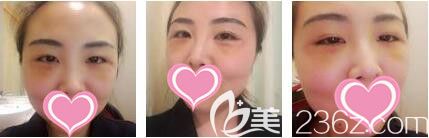 上海光博士医疗美容门诊部纪强自体脂肪填充泪沟真人案例术后第三天