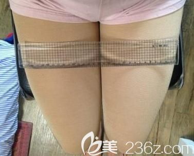 我在南宁梦想整形做大腿吸脂第30天 我在南宁梦想整形做大腿吸脂第30天