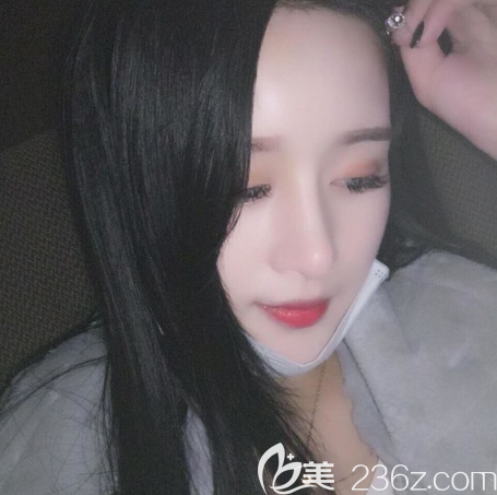 不得不说这次在东莞华美找詹慧院长做的自体脂肪面部填充不仅成活率高恢复也很快