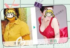 北京东方和谐冯氏贵妃自体脂肪丰胸案例