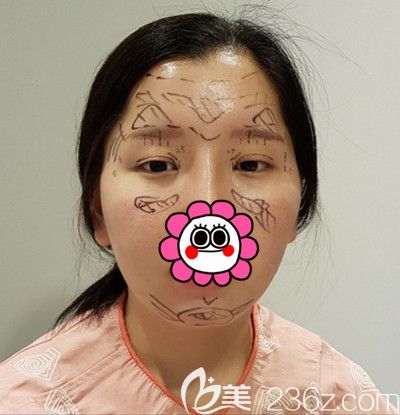 在韩国DI整形医院做全脸脂肪填充+全切双眼皮手术前设计