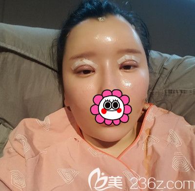在韩国DI整形医院做全脸脂肪填充+全切双眼皮手术后1天
